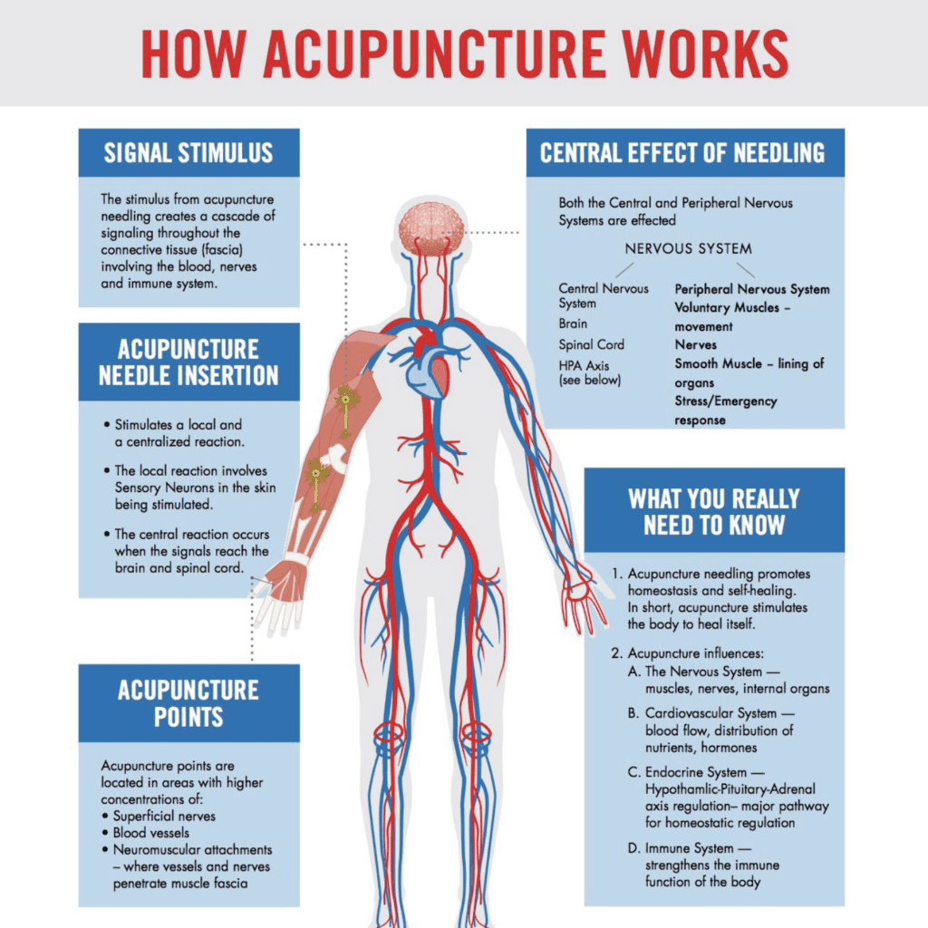 Accupuncture-For-Back-PainManagement