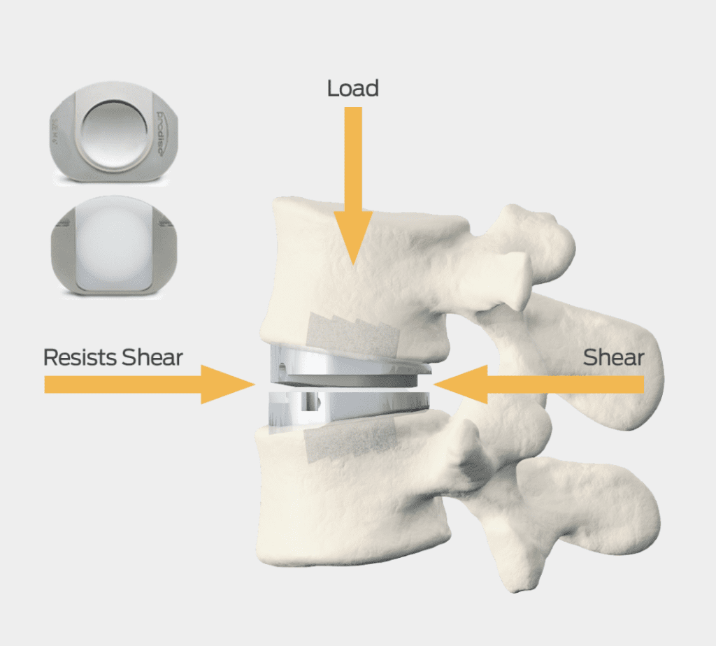 prodisc-l-anterior-lumbar-total-disc-replacement-mechanism-Action