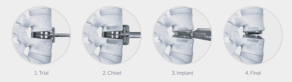 prodisc-l-anterior-lumbar-total-disc-replacement-process