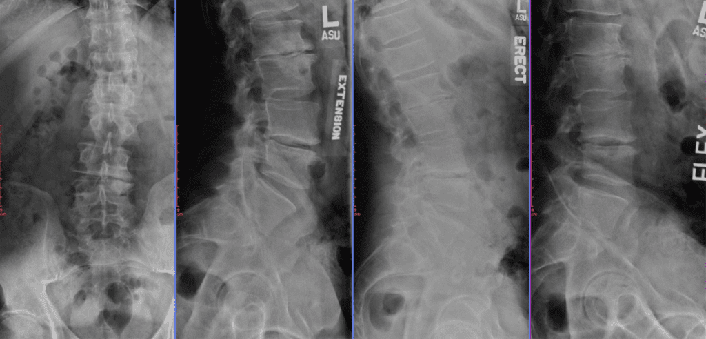 All-About-Scoliosis-What-Scoliosis-Looks-Like